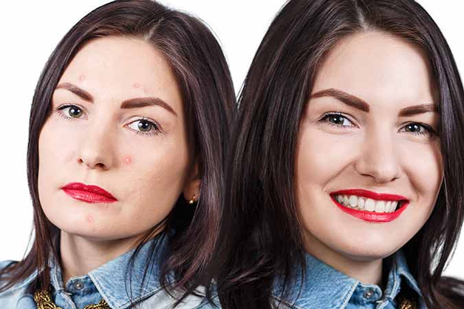 Effective treatment for acne scars in Bethesda