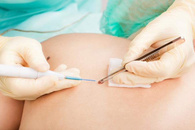 Dr Ronald B. Prussick, Washington Dermatology Center Providing Mole Removal