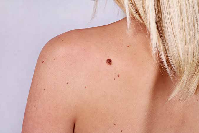 moles small skin problems that my Rockville dermatologist should remove