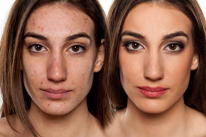 Acne before and After example