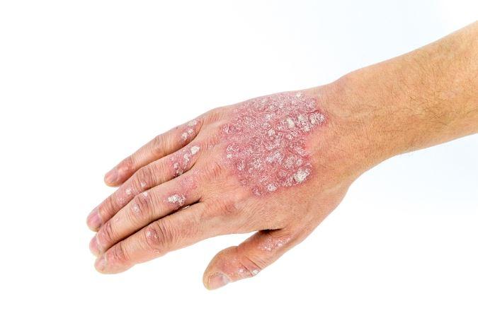 Psoriasis treatment from dermatologist in potomac