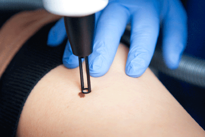 Skin Laser Treatment Urbana MD