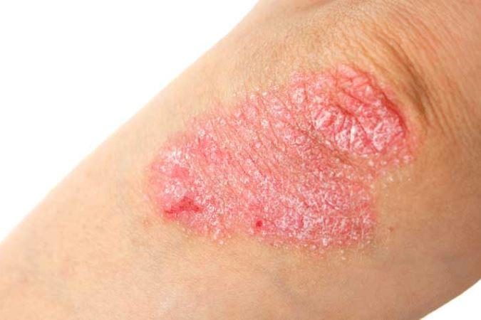 Psoriasis treatment from dermatologist in rockville